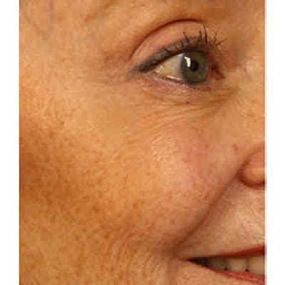 BOTOX, Dysport, Jeuveau, Xeomin Before & After Gallery - Patient 37504835 - Image 2