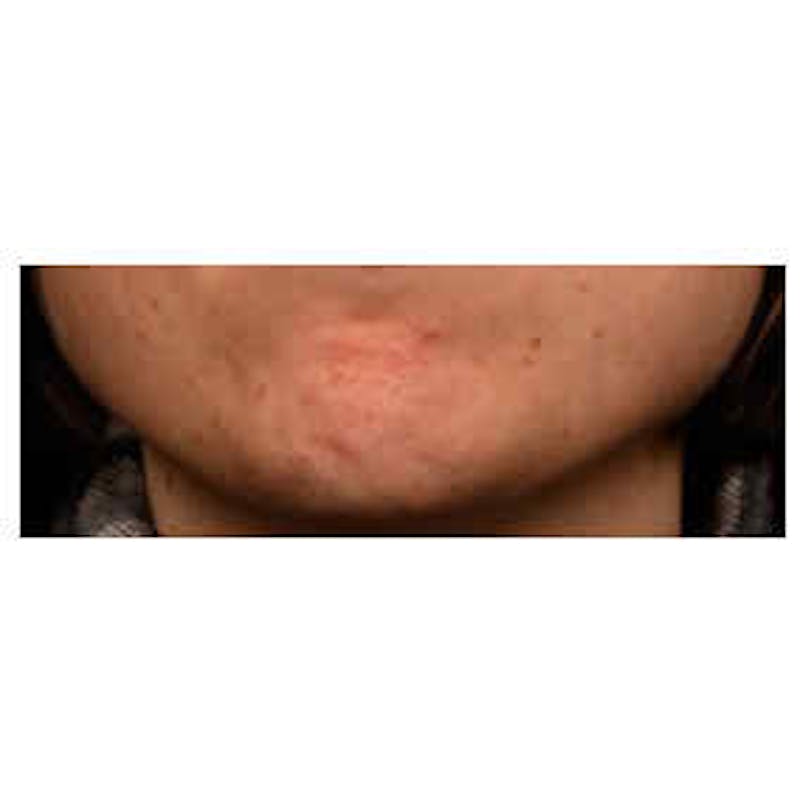 BOTOX, Dysport, Jeuveau, Xeomin Before & After Gallery - Patient 37504837 - Image 1