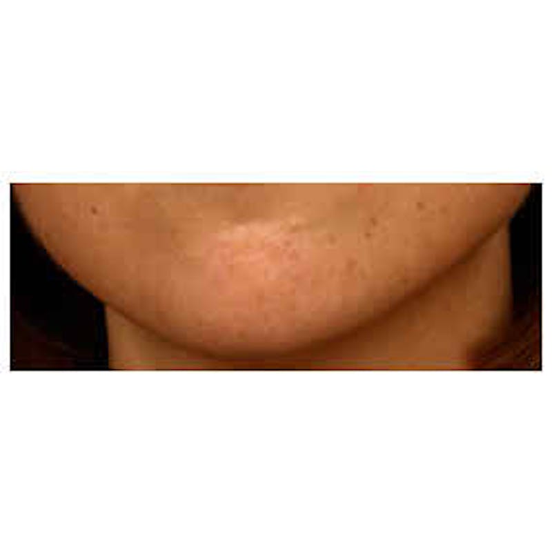 BOTOX, Dysport, Jeuveau, Xeomin Before & After Gallery - Patient 37504837 - Image 2