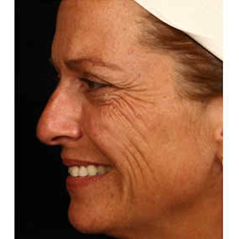 BOTOX, Dysport, Jeuveau, Xeomin Before & After Gallery - Patient 37504839 - Image 1