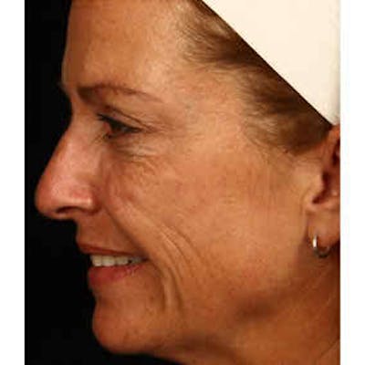 BOTOX, Dysport, Jeuveau, Xeomin Before & After Gallery - Patient 37504839 - Image 2