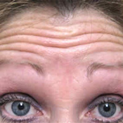 BOTOX, Dysport, Jeuveau, Xeomin Before & After Gallery - Patient 37504841 - Image 1