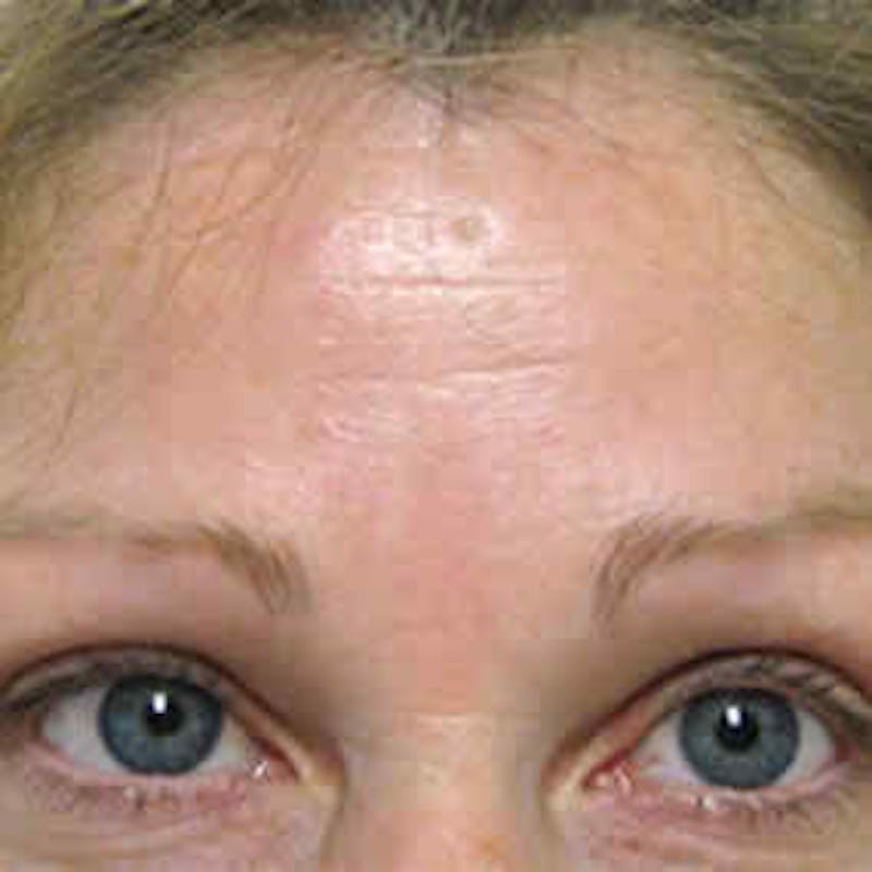 BOTOX, Dysport, Jeuveau, Xeomin Before & After Gallery - Patient 37504841 - Image 2