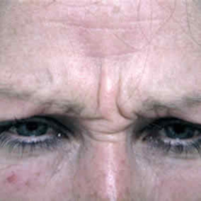 BOTOX, Dysport, Jeuveau, Xeomin Before & After Gallery - Patient 37504843 - Image 1