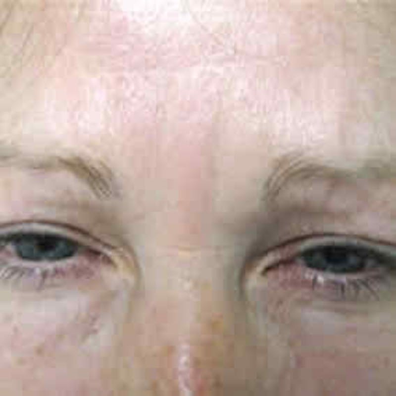 BOTOX, Dysport, Jeuveau, Xeomin Before & After Gallery - Patient 37504843 - Image 2
