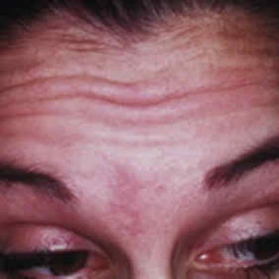 BOTOX, Dysport, Jeuveau, Xeomin Before & After Gallery - Patient 37504846 - Image 1