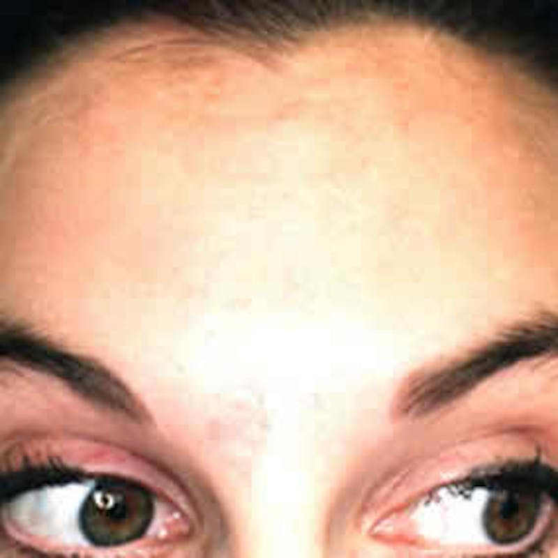 BOTOX, Dysport, Jeuveau, Xeomin Before & After Gallery - Patient 37504846 - Image 2