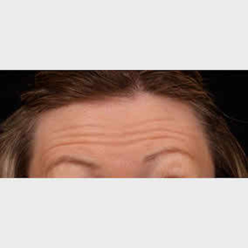 Botox & Dysport Before & After Gallery - Patient 37504848 - Image 1