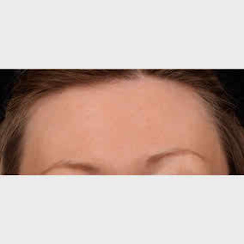 BOTOX, Dysport, Jeuveau, Xeomin Before & After Gallery - Patient 37504848 - Image 2