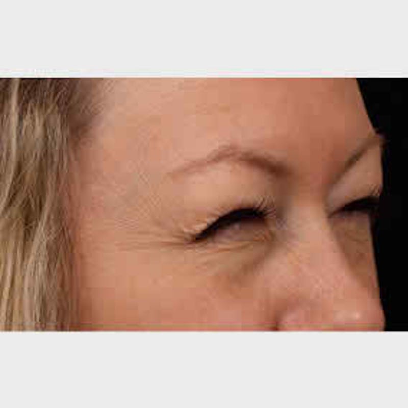 BOTOX, Dysport, Jeuveau, Xeomin Before & After Gallery - Patient 37504850 - Image 1