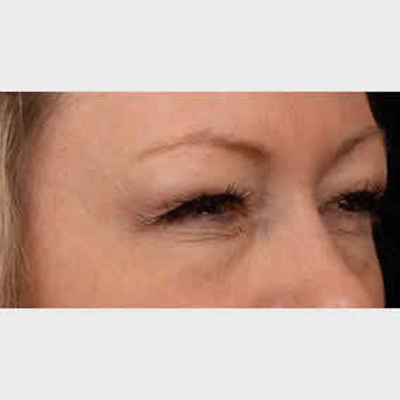 Botox & Dysport Before & After Gallery - Patient 37504850 - Image 2