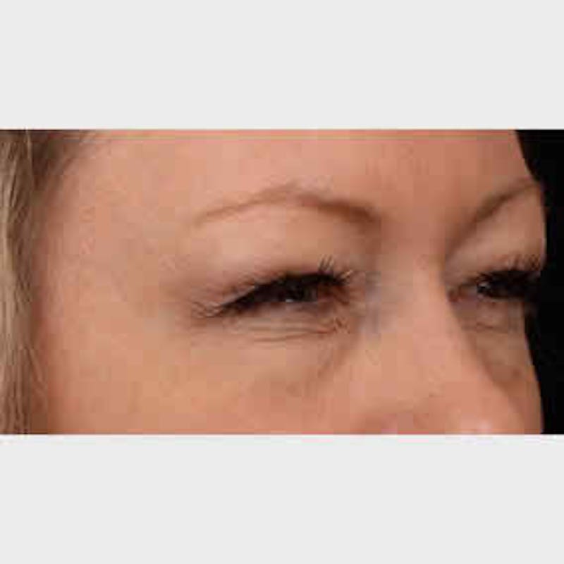 BOTOX, Dysport, Jeuveau, Xeomin Before & After Gallery - Patient 37504850 - Image 2