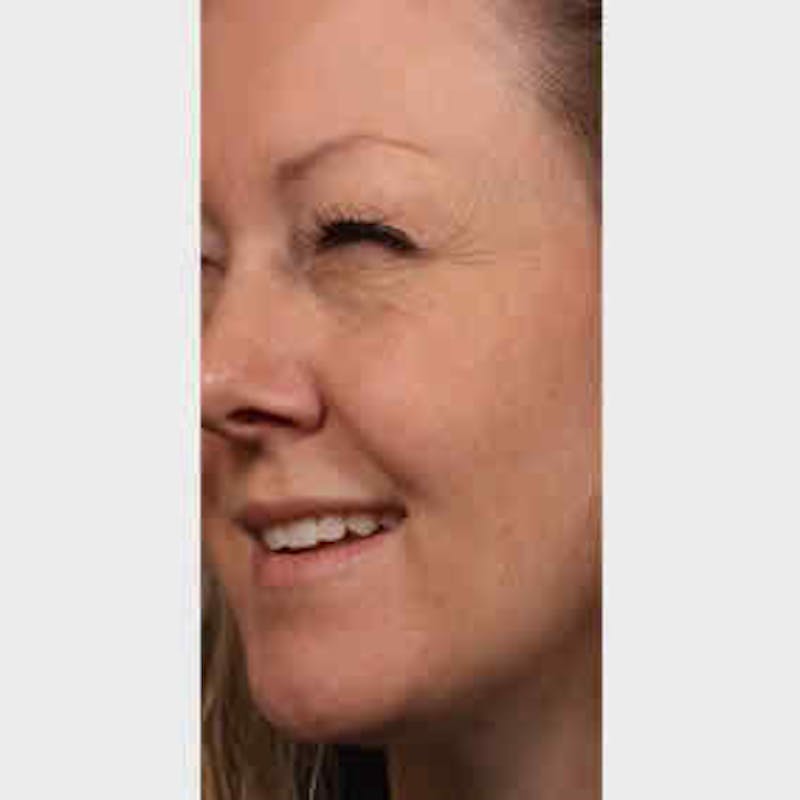 BOTOX, Dysport, Jeuveau, Xeomin Before & After Gallery - Patient 37504852 - Image 1