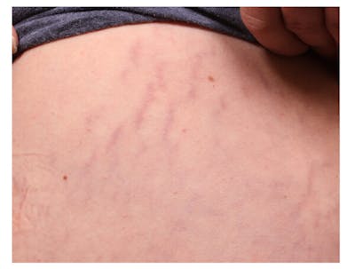 Stretchmarks Before & After Gallery - Patient 37499697 - Image 1