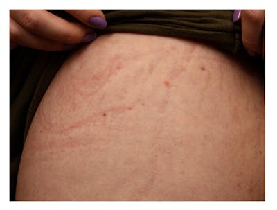 Stretchmarks Before & After Gallery - Patient 37499697 - Image 2