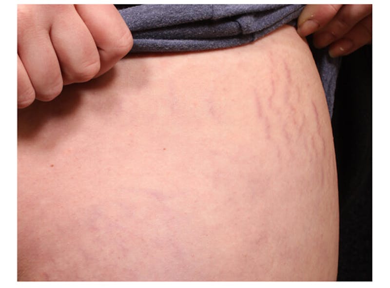 Stretchmarks Before & After Gallery - Patient 37499697 - Image 3