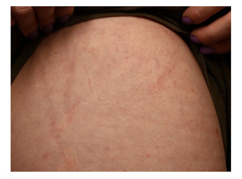 Stretchmarks Before & After Gallery - Patient 37499697 - Image 4