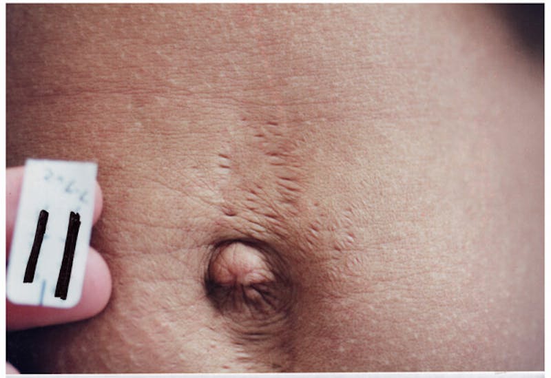 Stretchmarks Before & After Gallery - Patient 37499689 - Image 1