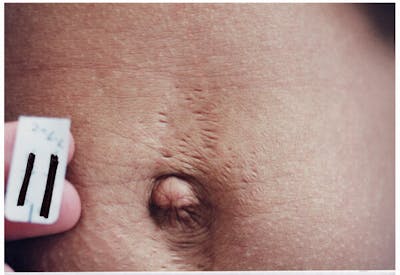 Stretchmarks Before & After Gallery - Patient 37499689 - Image 1
