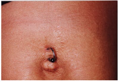 Stretchmarks Before & After Gallery - Patient 37499689 - Image 2