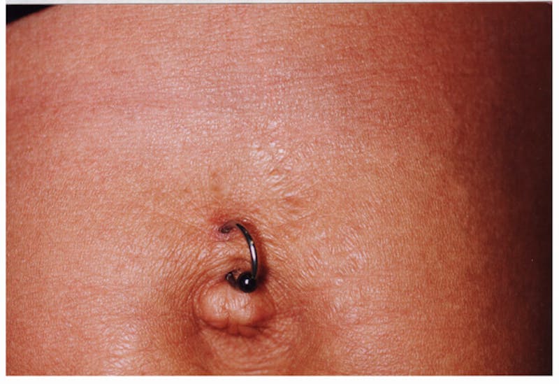 Stretchmarks Before & After Gallery - Patient 37499689 - Image 2