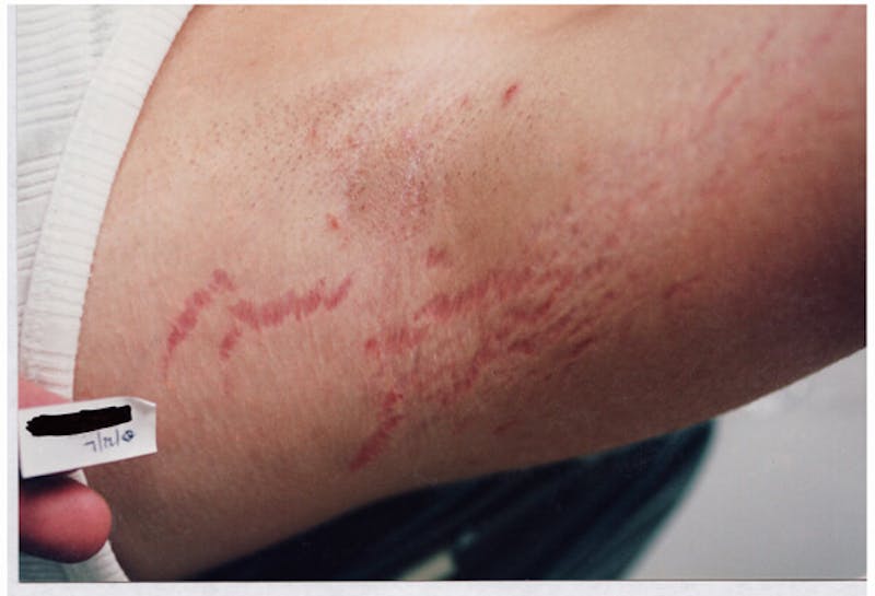 Stretchmarks Before & After Gallery - Patient 37499693 - Image 1