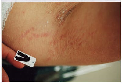 Stretchmarks Before & After Gallery - Patient 37499693 - Image 2