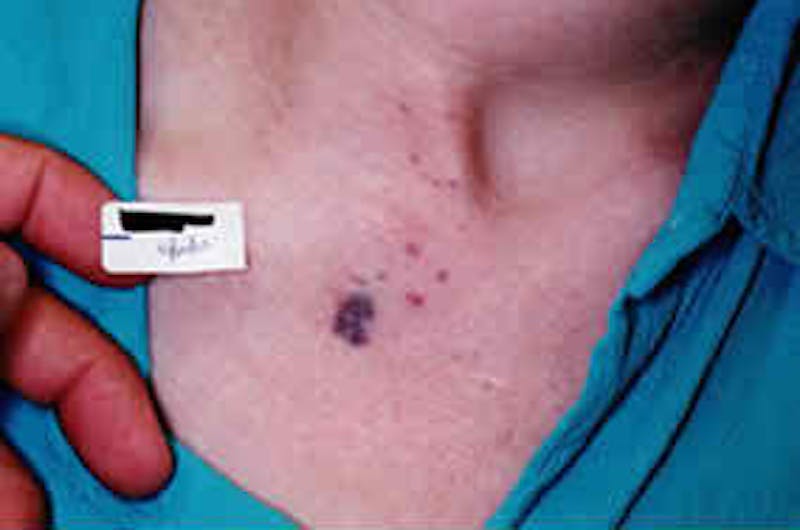 Birthmark and Hemangiomas Laser Treatments Before & After Gallery - Patient 37499384 - Image 1