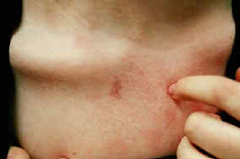 Birthmark and Hemangiomas Laser Treatments Before & After Gallery - Patient 37499384 - Image 2