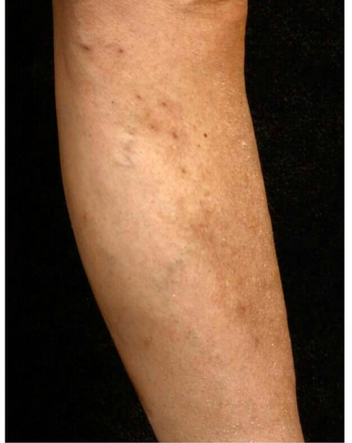 Ambulatory Phlebectomy Before & After Gallery - Patient 37499162 - Image 2