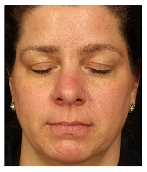BBL: Forever Young (Broad Band Light) Before & After Gallery - Patient 37499294 - Image 2