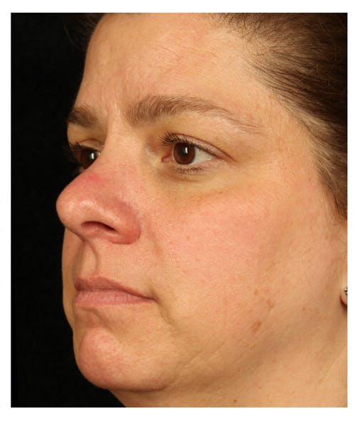 BBL: Forever Young (Broad Band Light) Before & After Gallery - Patient 37499294 - Image 4