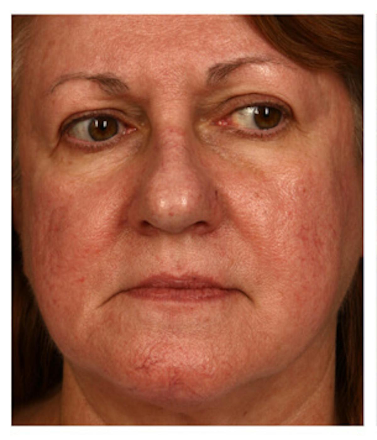 BBL: Forever Young (Broad Band Light) Before & After Gallery - Patient 37499305 - Image 1