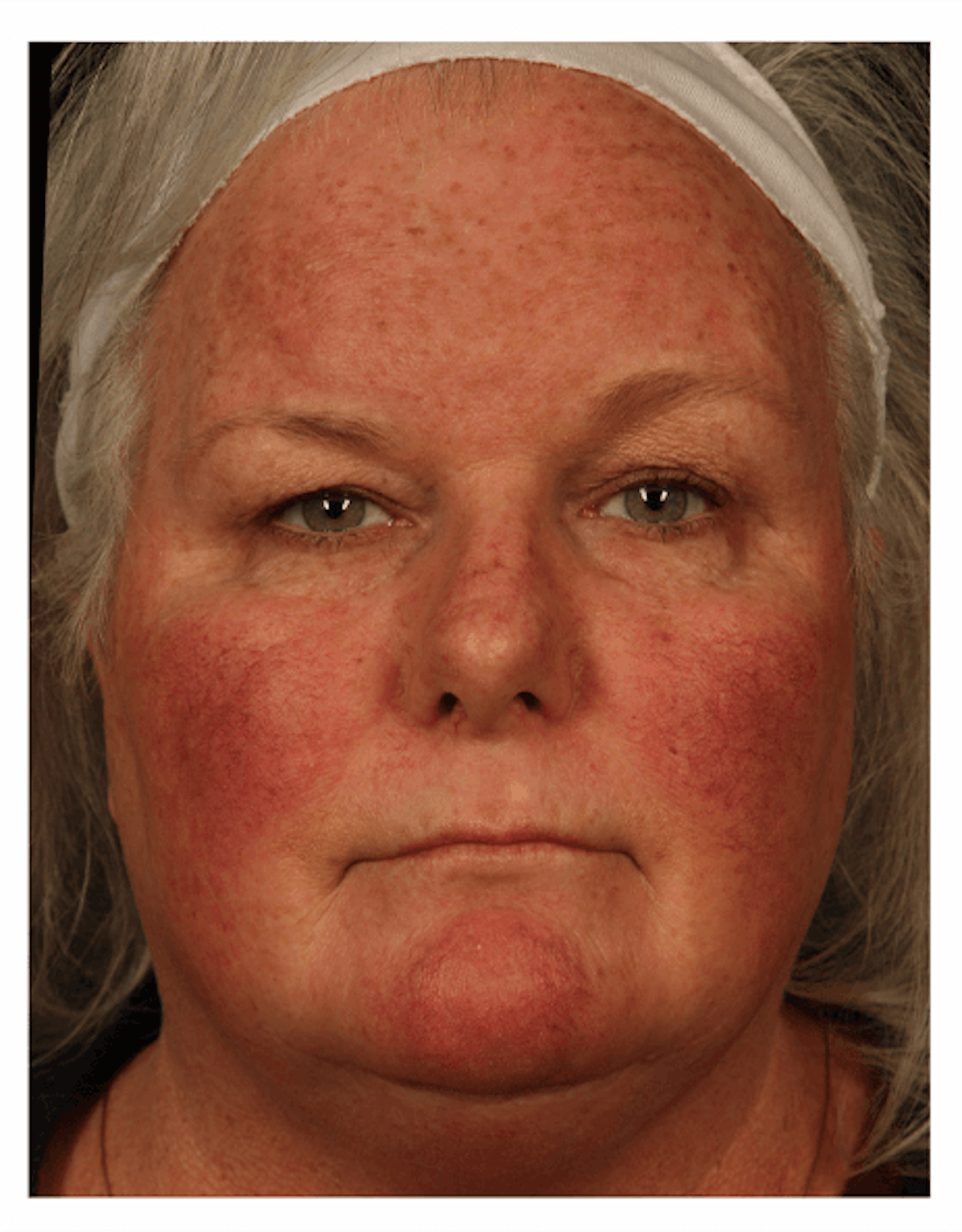 BBL: Forever Young (Broad Band Light) Before & After Gallery - Patient 37499311 - Image 1