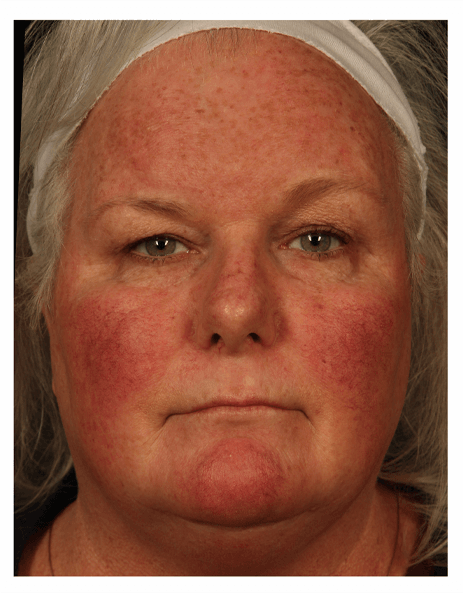 BBL: Forever Young (Broad Band Light) Before & After Gallery - Patient 37499311 - Image 1