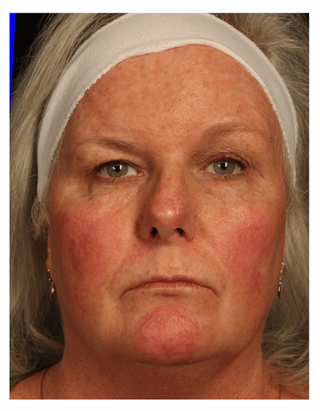 BBL: Forever Young (Broad Band Light) Before & After Gallery - Patient 37499311 - Image 2