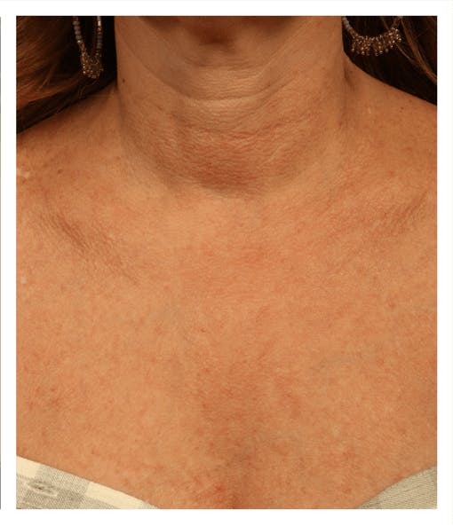 BBL: Forever Young (Broad Band Light) Before & After Gallery - Patient 37499322 - Image 2