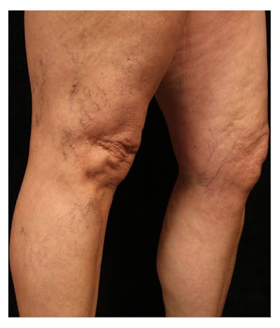 Ultrasound Guided Sclerotherapy Before & After Gallery - Patient 37499735 - Image 1