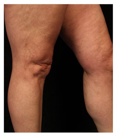 Ultrasound Guided Sclerotherapy Before & After Gallery - Patient 37499735 - Image 2