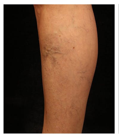 Ultrasound Guided Sclerotherapy Before & After Gallery - Patient 37499741 - Image 1