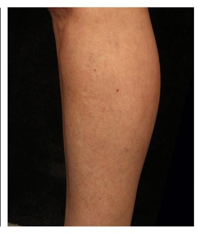 Ultrasound Guided Sclerotherapy Before & After Gallery - Patient 37499741 - Image 2