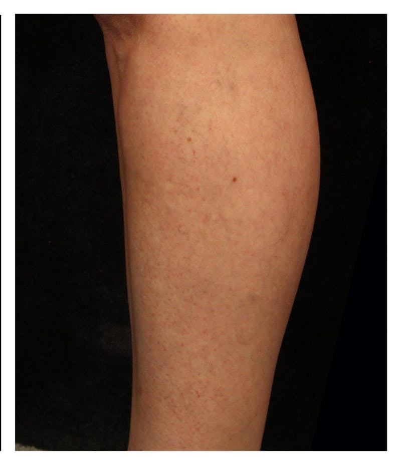 Ultrasound Guided Sclerotherapy Before & After Gallery - Patient 37499741 - Image 2