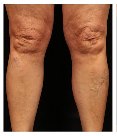 Ultrasound Guided Sclerotherapy Before & After Gallery - Patient 37499747 - Image 1