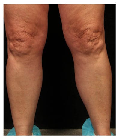 Ultrasound Guided Sclerotherapy Before & After Gallery - Patient 37499747 - Image 2