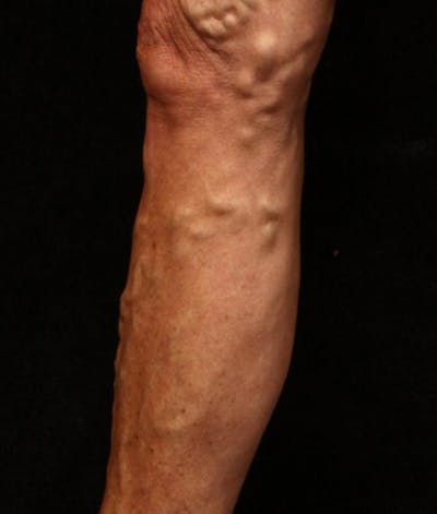 Varicose Veins Before & After Gallery - Patient 37499745 - Image 1