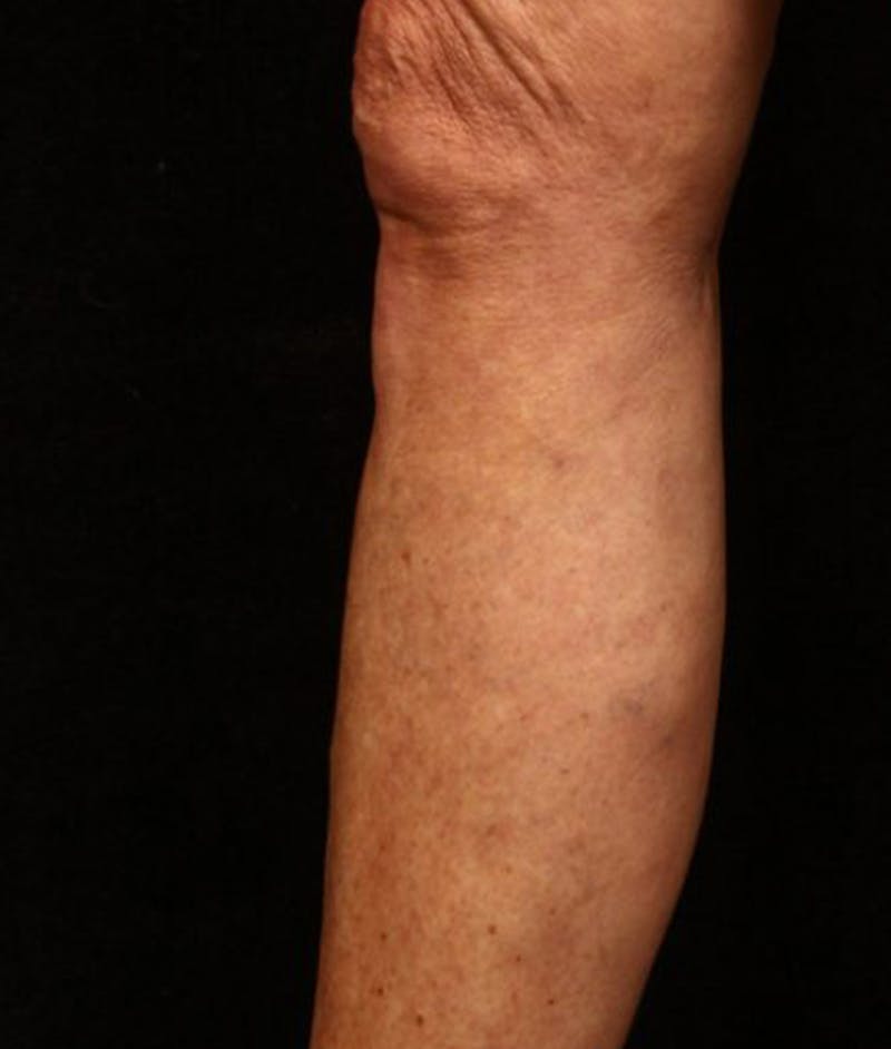 Varicose Veins Before & After Gallery - Patient 37499745 - Image 2