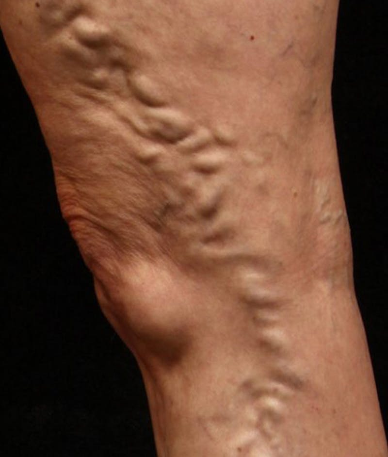 Varicose Veins Before & After Gallery - Patient 37499750 - Image 1