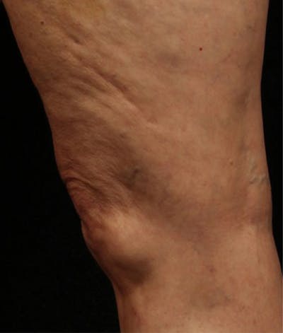 Varicose Veins Before & After Gallery - Patient 37499750 - Image 2