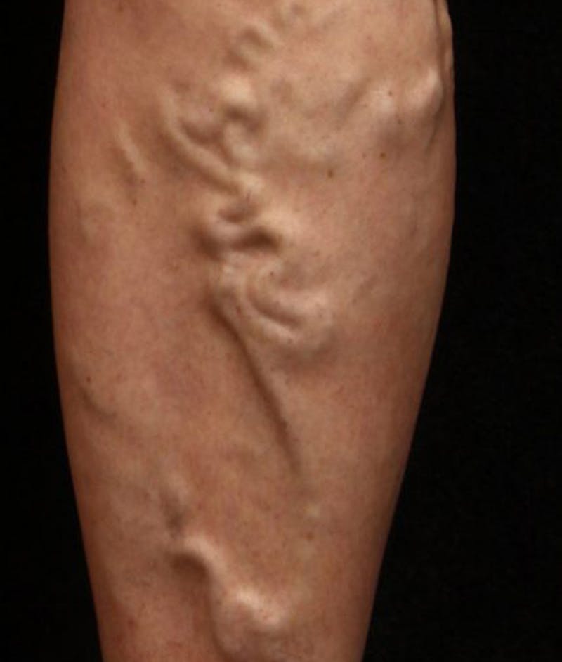 Varicose Veins Before & After Gallery - Patient 37499755 - Image 1