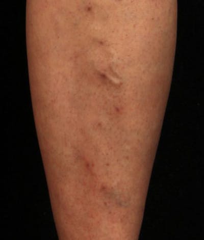 Varicose Veins Before & After Gallery - Patient 37499755 - Image 2